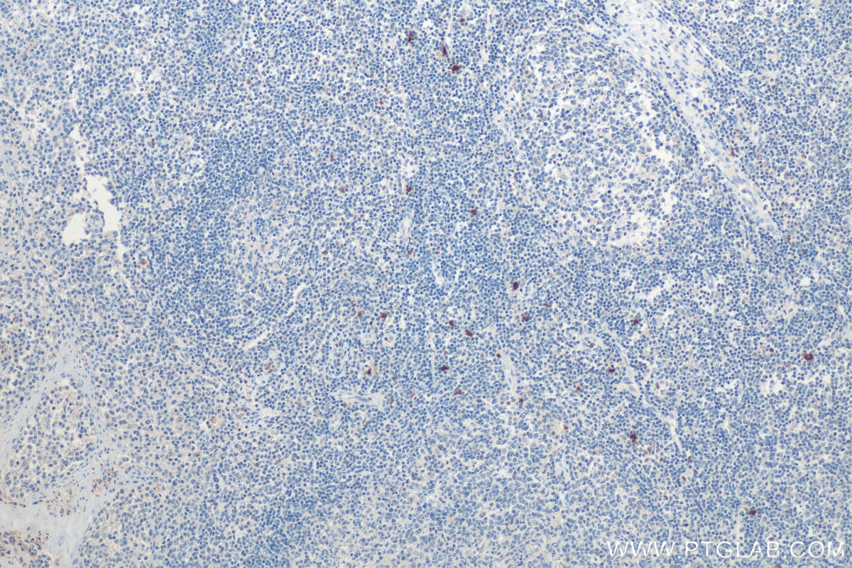Immunohistochemistry (IHC) staining of human tonsillitis tissue using Mast Cell Chymase Polyclonal antibody (18189-1-AP)