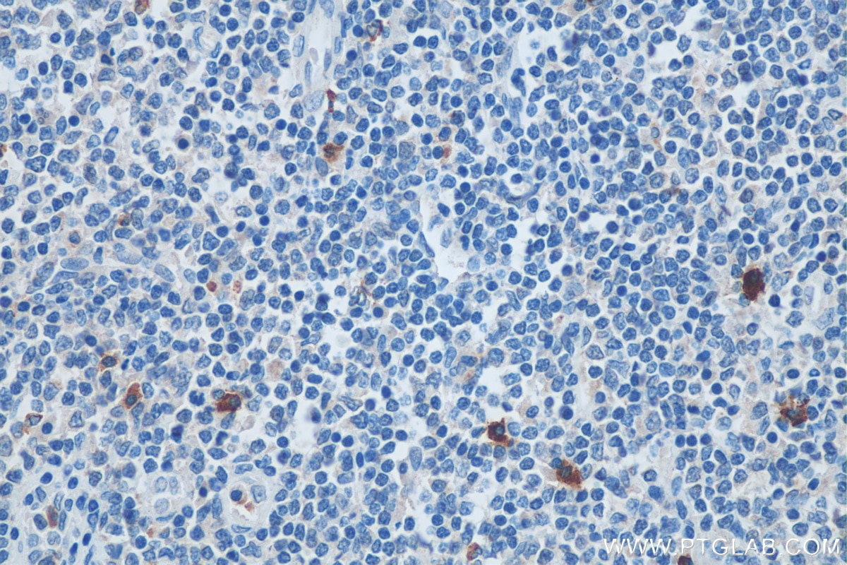 IHC staining of human tonsillitis using 18189-1-AP