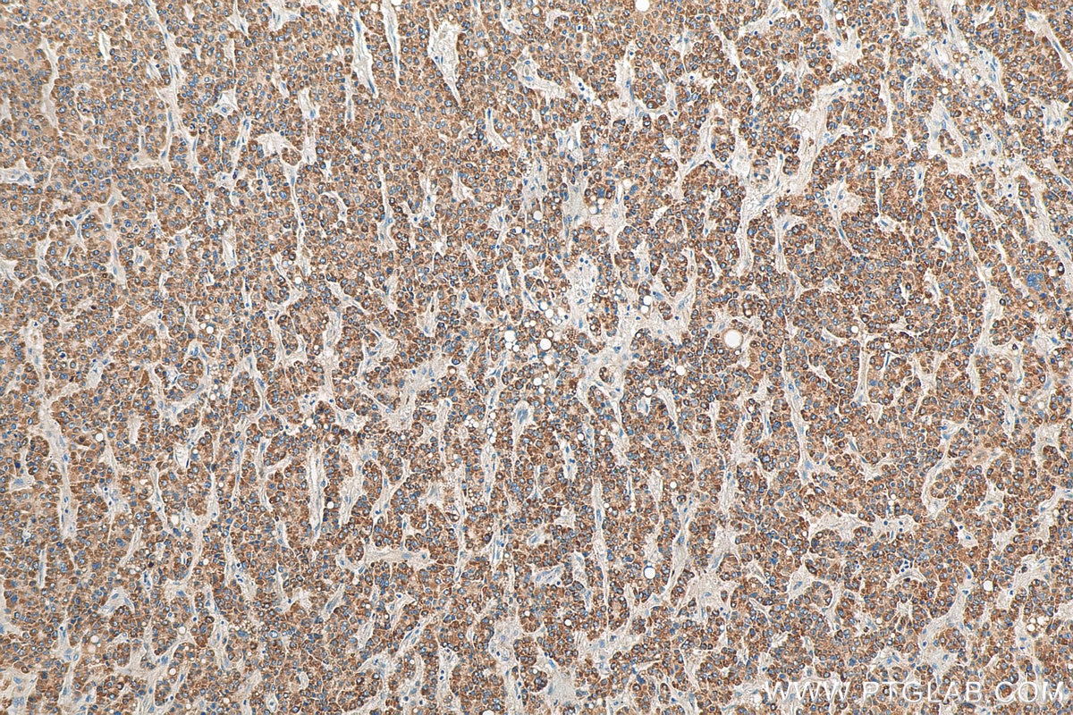 Immunohistochemistry (IHC) staining of human liver cancer tissue using CMC1 Polyclonal antibody (24030-1-AP)
