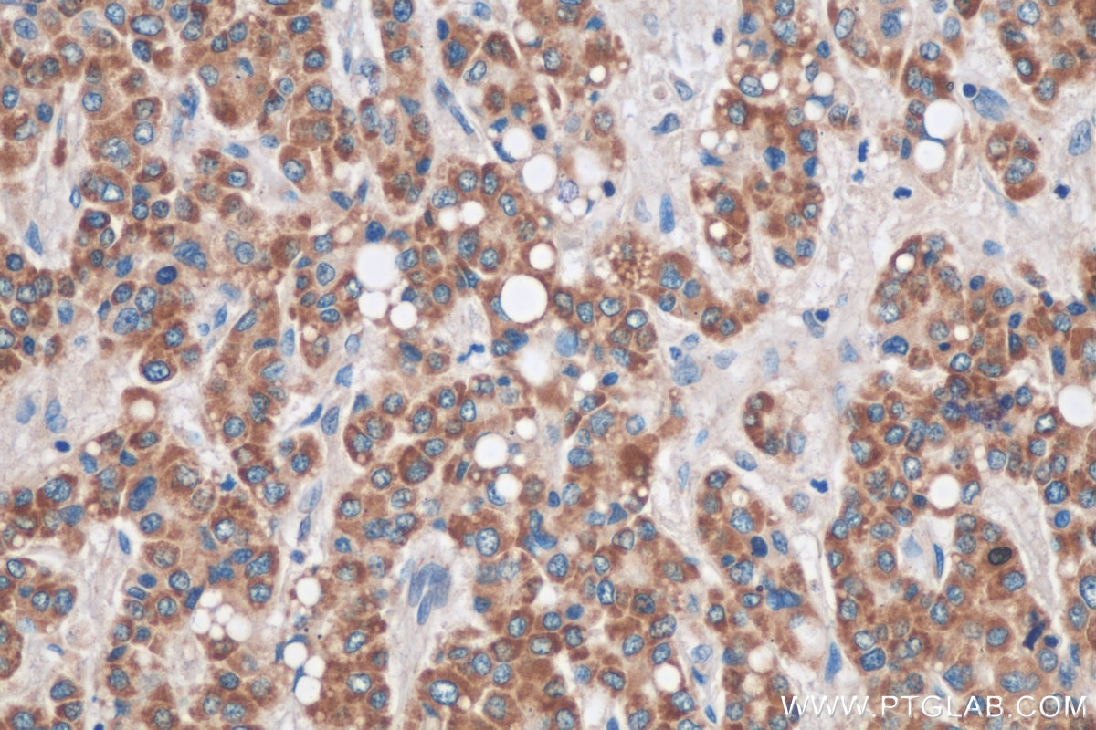 Immunohistochemistry (IHC) staining of human liver cancer tissue using CMC1 Polyclonal antibody (24030-1-AP)