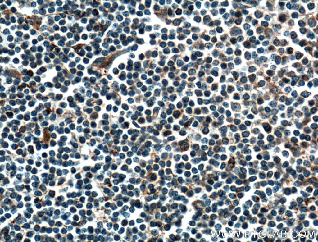 Immunohistochemistry (IHC) staining of human lymphoma tissue using CMIP Polyclonal antibody (12851-1-AP)