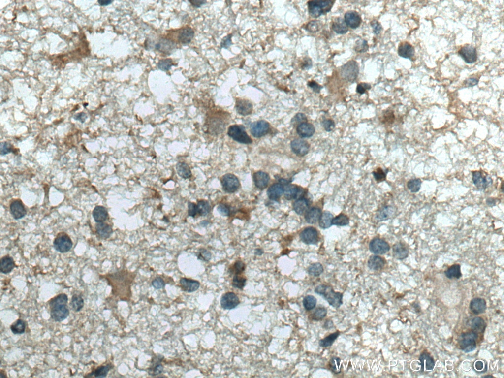 Immunohistochemistry (IHC) staining of human gliomas tissue using CMIP Polyclonal antibody (12851-1-AP)