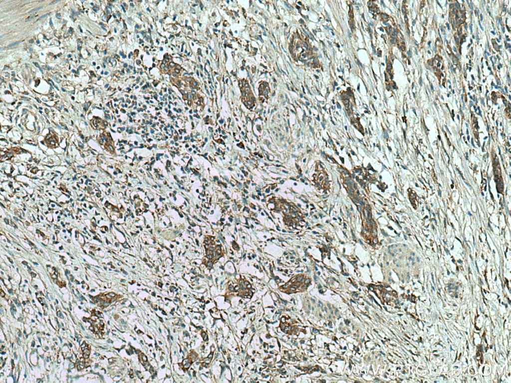 Immunohistochemistry (IHC) staining of human stomach cancer tissue using CMIP Polyclonal antibody (12851-1-AP)