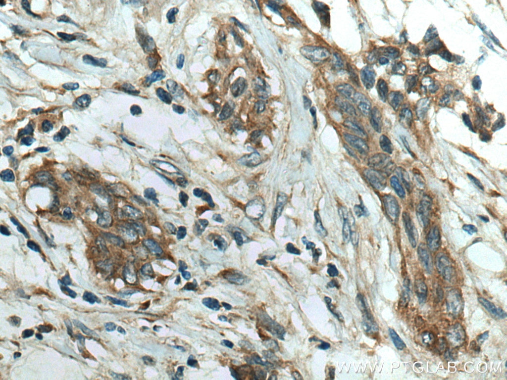 Immunohistochemistry (IHC) staining of human stomach cancer tissue using CMIP Polyclonal antibody (12851-1-AP)