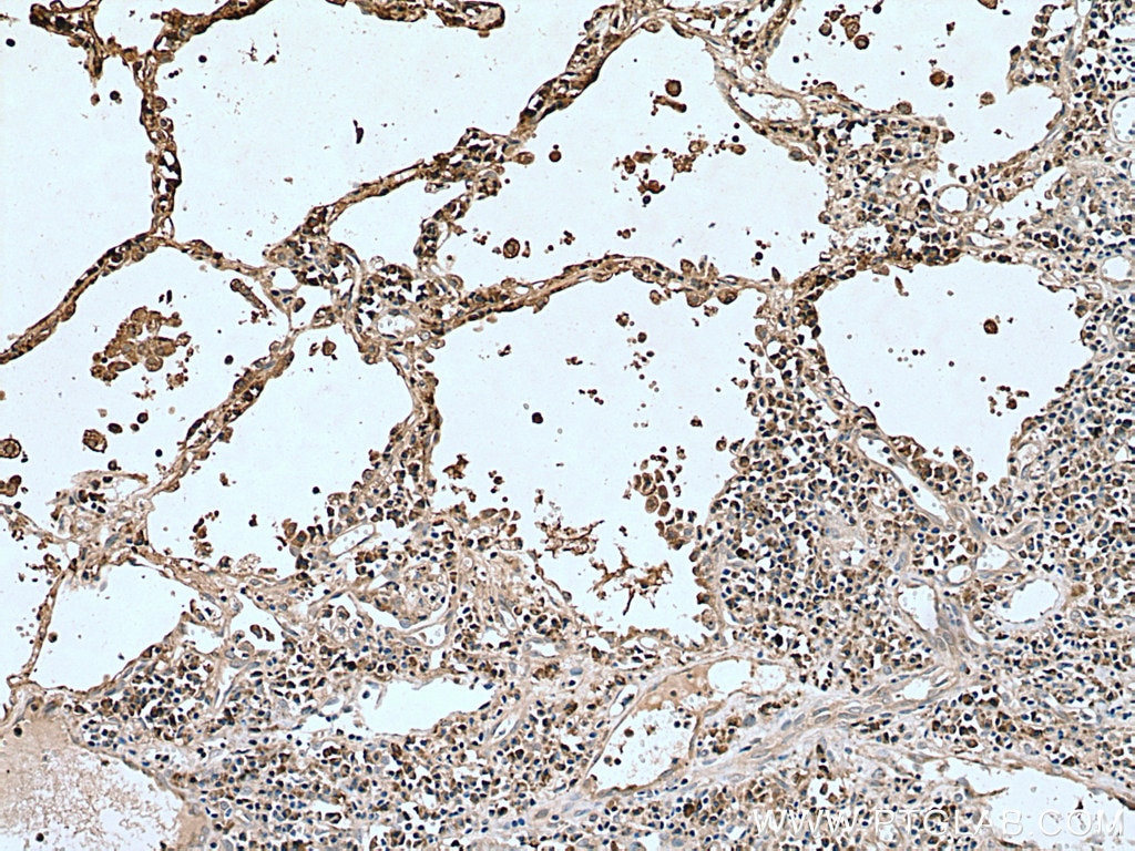 Immunohistochemistry (IHC) staining of human lung cancer tissue using CMIP Polyclonal antibody (12851-1-AP)