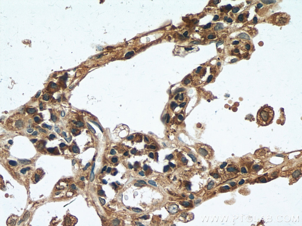 Immunohistochemistry (IHC) staining of human lung cancer tissue using CMIP Polyclonal antibody (12851-1-AP)