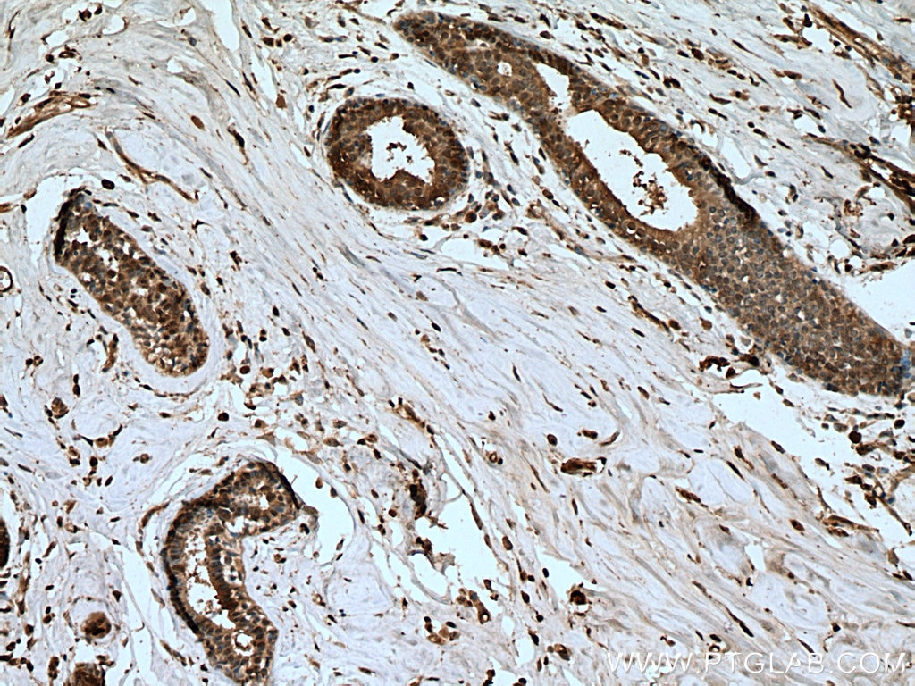 Immunohistochemistry (IHC) staining of human breast cancer tissue using UMP/CMP kinase Polyclonal antibody (11360-1-AP)
