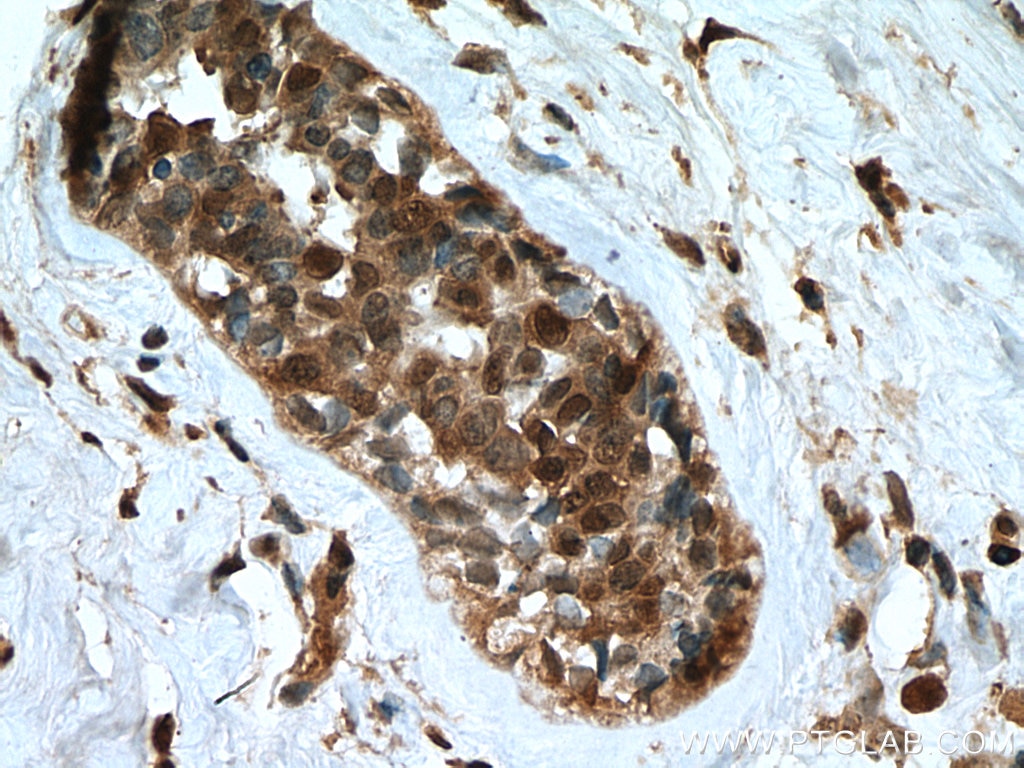 Immunohistochemistry (IHC) staining of human breast cancer tissue using UMP/CMP kinase Polyclonal antibody (11360-1-AP)