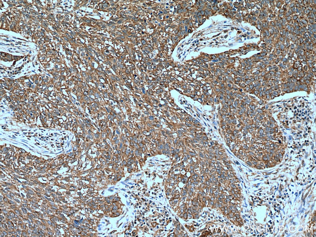 Immunohistochemistry (IHC) staining of human lung cancer tissue using UMP/CMP kinase Polyclonal antibody (11360-1-AP)