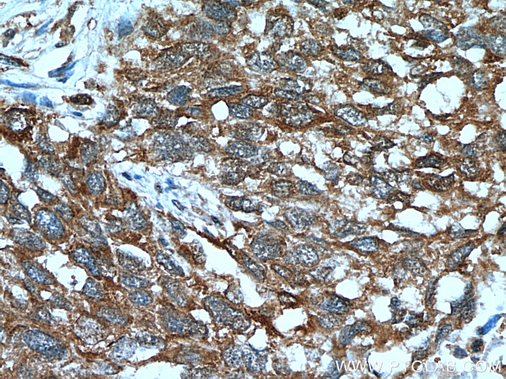 Immunohistochemistry (IHC) staining of human lung cancer tissue using UMP/CMP kinase Polyclonal antibody (11360-1-AP)