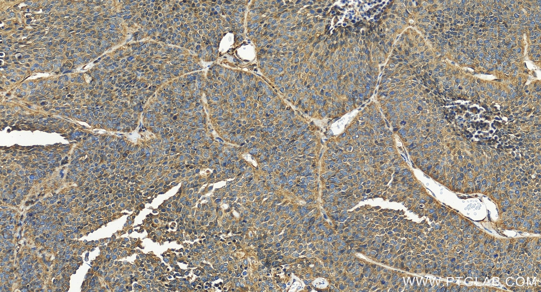 Immunohistochemistry (IHC) staining of human lung cancer tissue using UMP/CMP kinase Recombinant monoclonal antibody (86475-1-RR)
