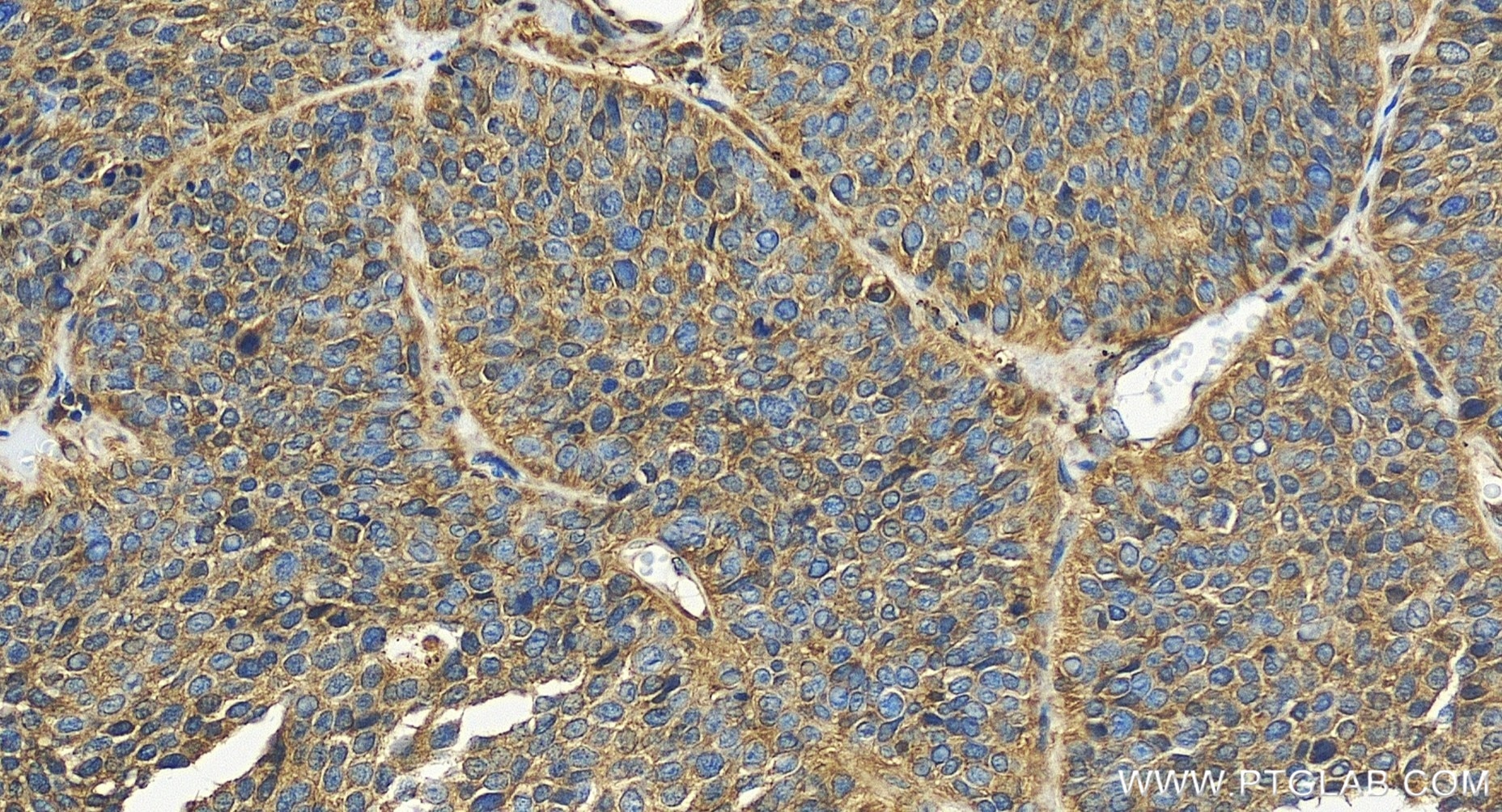 Immunohistochemistry (IHC) staining of human lung cancer tissue using UMP/CMP kinase Recombinant monoclonal antibody (86475-1-RR)