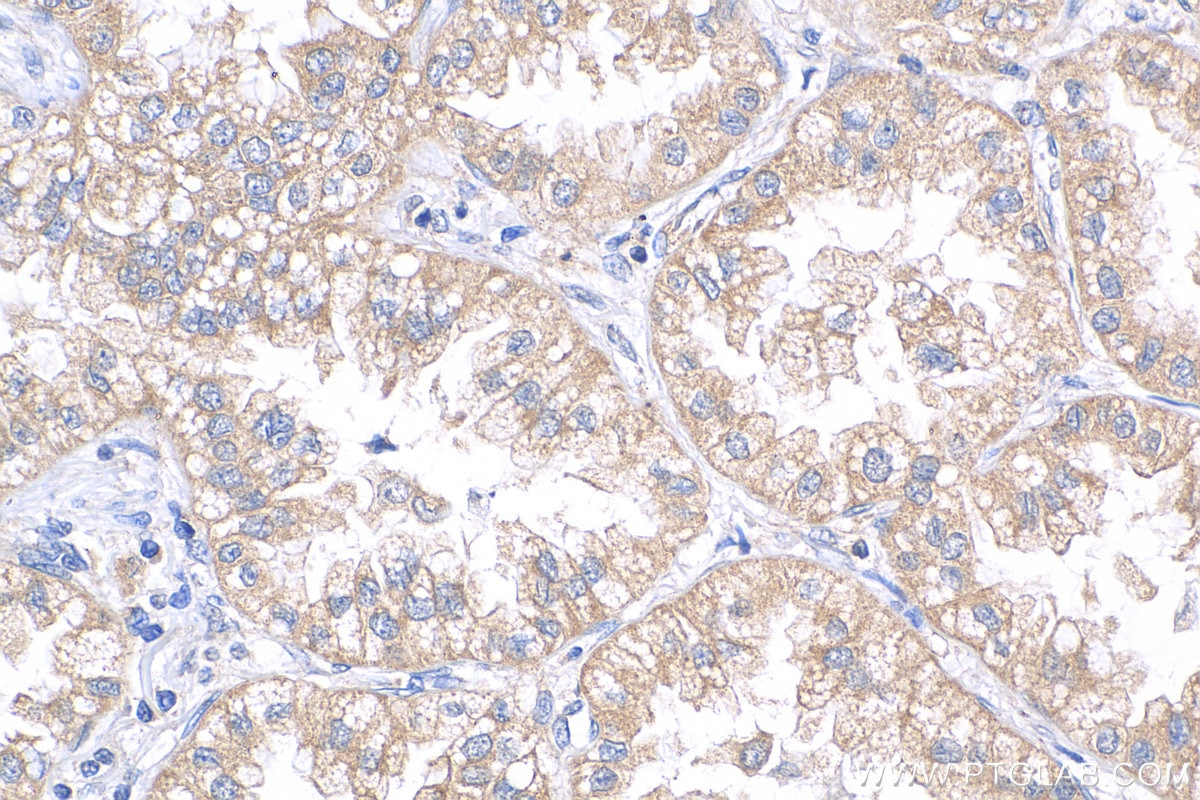 Immunohistochemistry (IHC) staining of human lung cancer tissue using CMPK2 Polyclonal antibody (25877-1-AP)