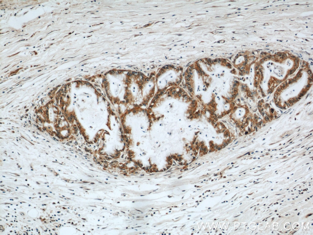 Immunohistochemistry (IHC) staining of human pancreas cancer tissue using CMTM8 Polyclonal antibody (15039-1-AP)