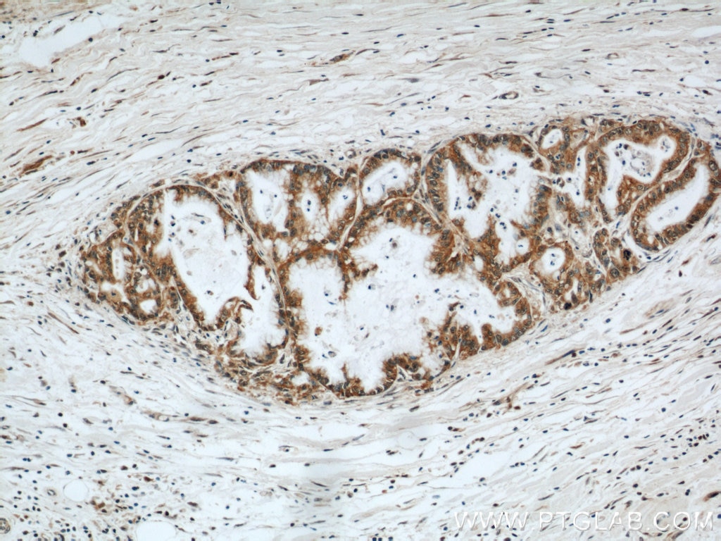 IHC staining of human pancreas cancer using 15039-1-AP