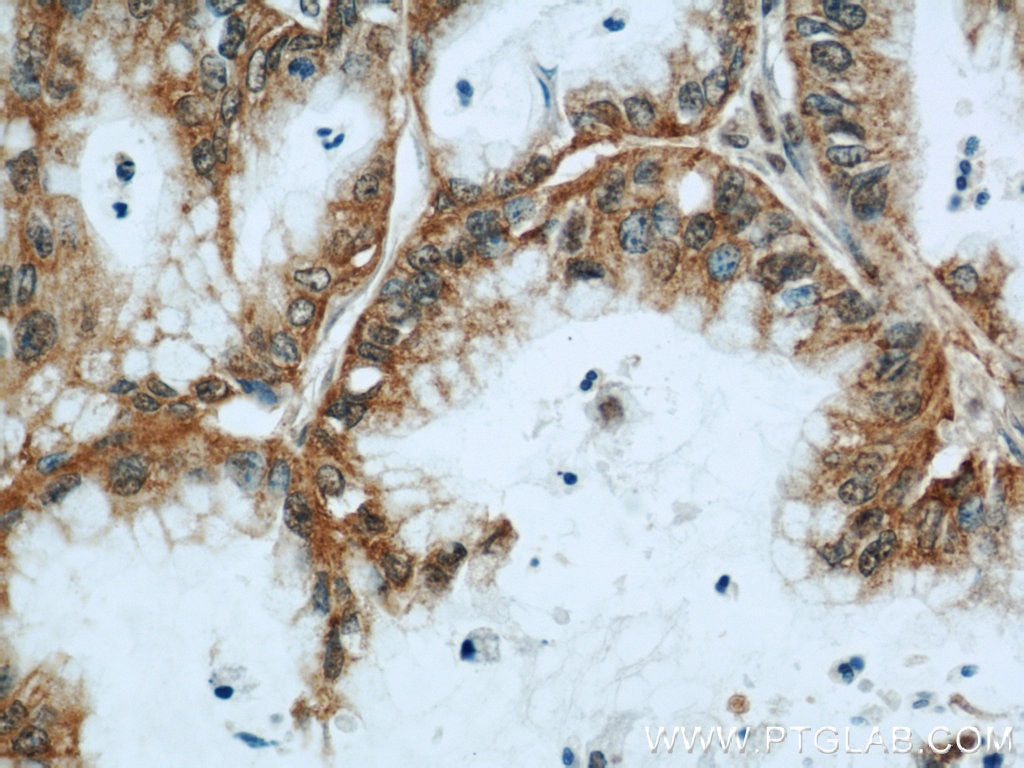 Immunohistochemistry (IHC) staining of human pancreas cancer tissue using CMTM8 Polyclonal antibody (15039-1-AP)