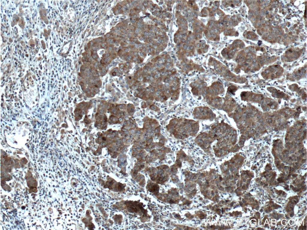 Immunohistochemistry (IHC) staining of human prostate cancer tissue using CNDP1 Polyclonal antibody (17759-1-AP)
