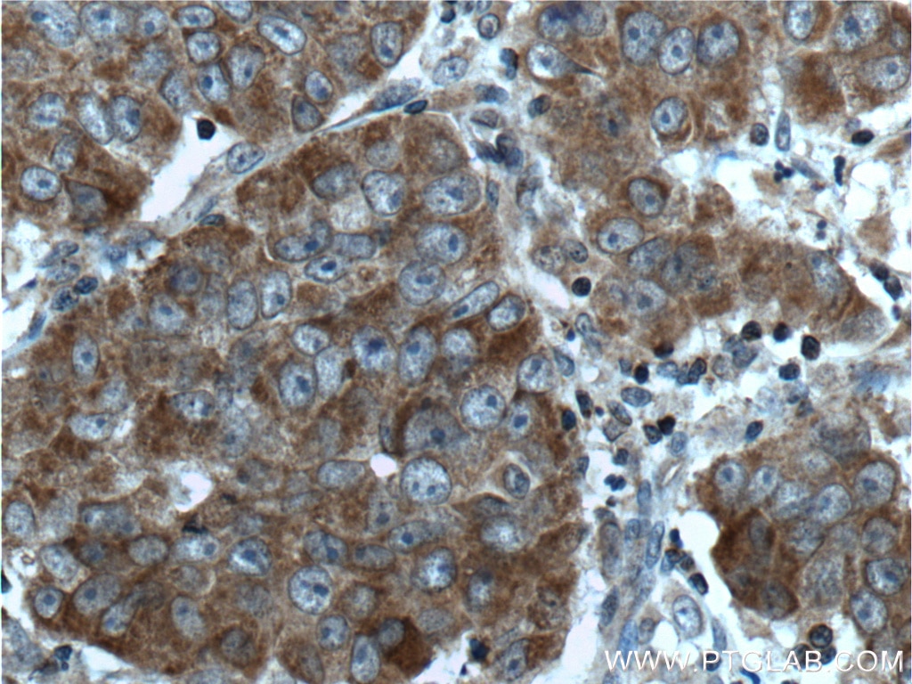 Immunohistochemistry (IHC) staining of human prostate cancer tissue using CNDP1 Polyclonal antibody (17759-1-AP)
