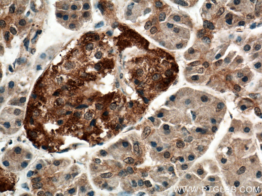 Immunohistochemistry (IHC) staining of human pancreas cancer tissue using CNKSR1 Polyclonal antibody (10885-1-AP)