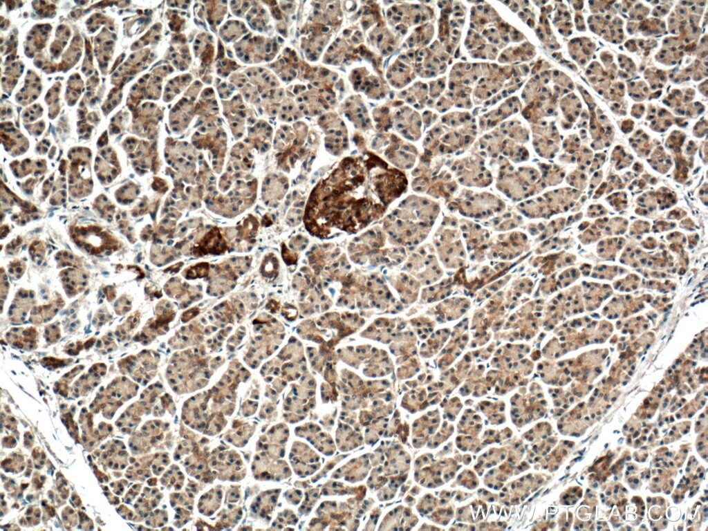 Immunohistochemistry (IHC) staining of human pancreas cancer tissue using CNKSR1 Polyclonal antibody (10885-1-AP)