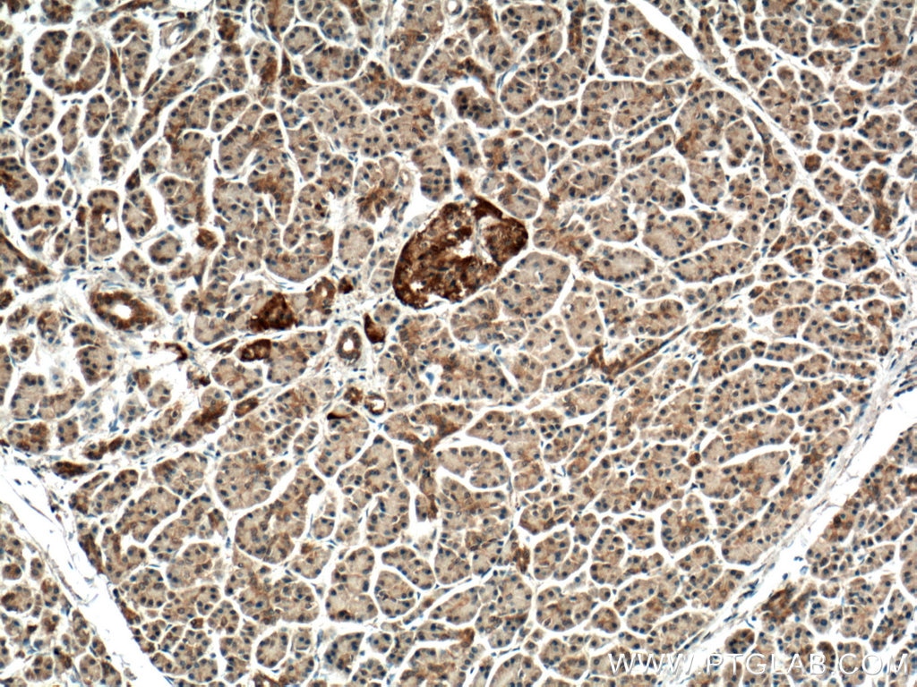 IHC staining of human pancreas cancer using 10885-1-AP