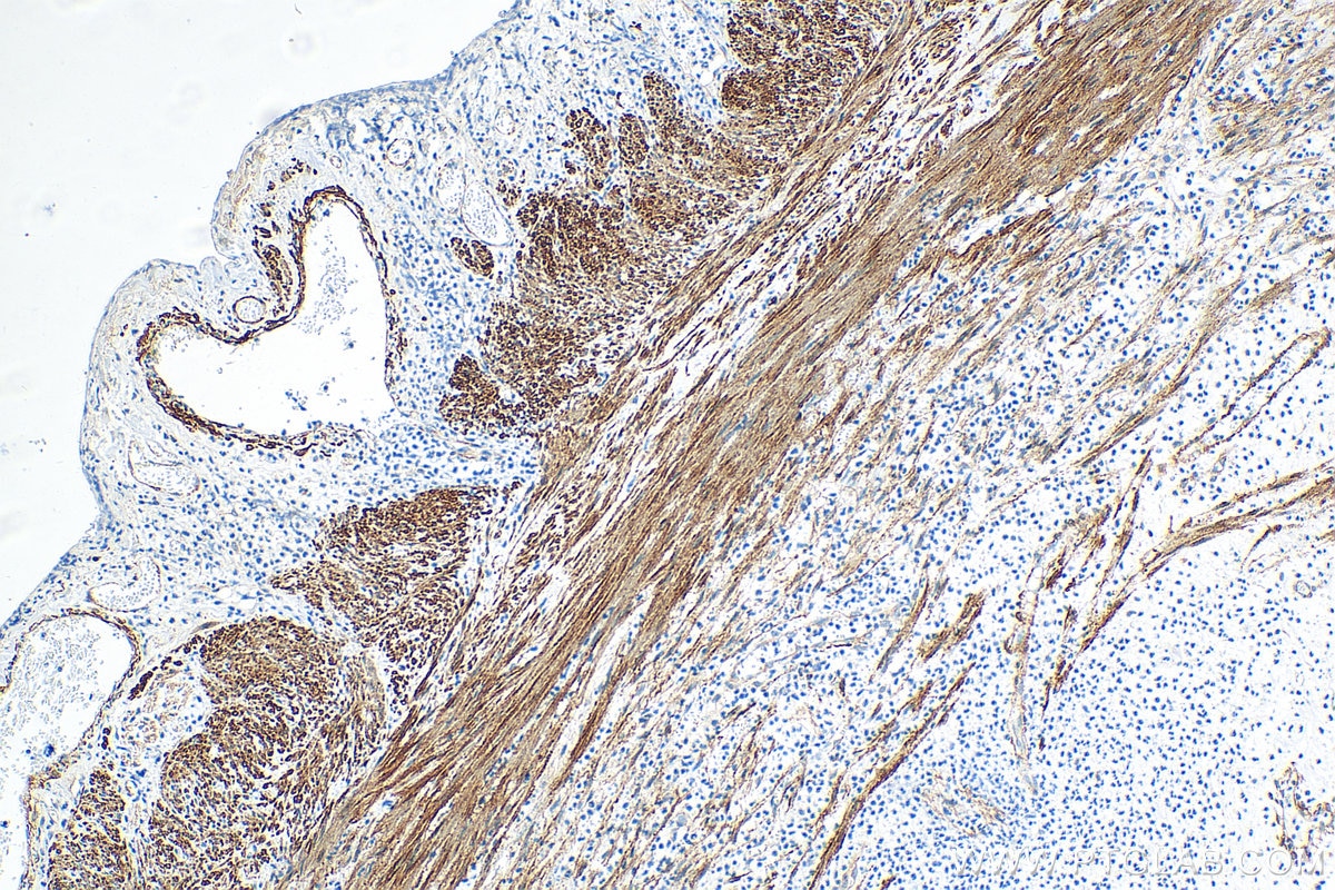 IHC staining of human appendicitis using 13938-1-AP