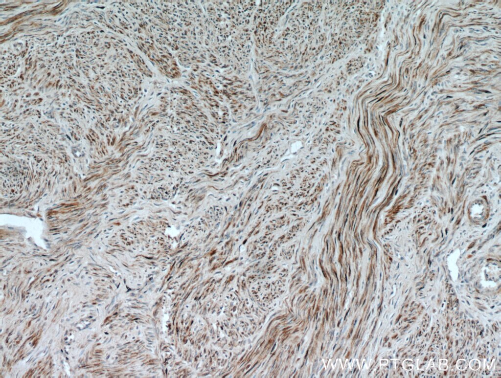 Immunohistochemistry (IHC) staining of human hysteromyoma tissue using Calponin Polyclonal antibody (13938-1-AP)