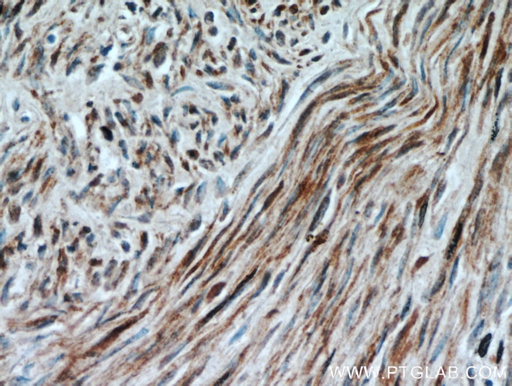 Immunohistochemistry (IHC) staining of human hysteromyoma tissue using Calponin Polyclonal antibody (13938-1-AP)