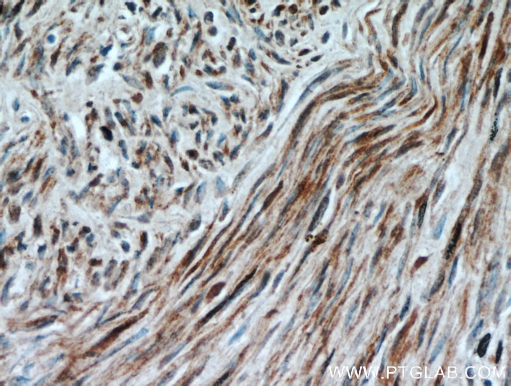 IHC staining of human hysteromyoma using 13938-1-AP