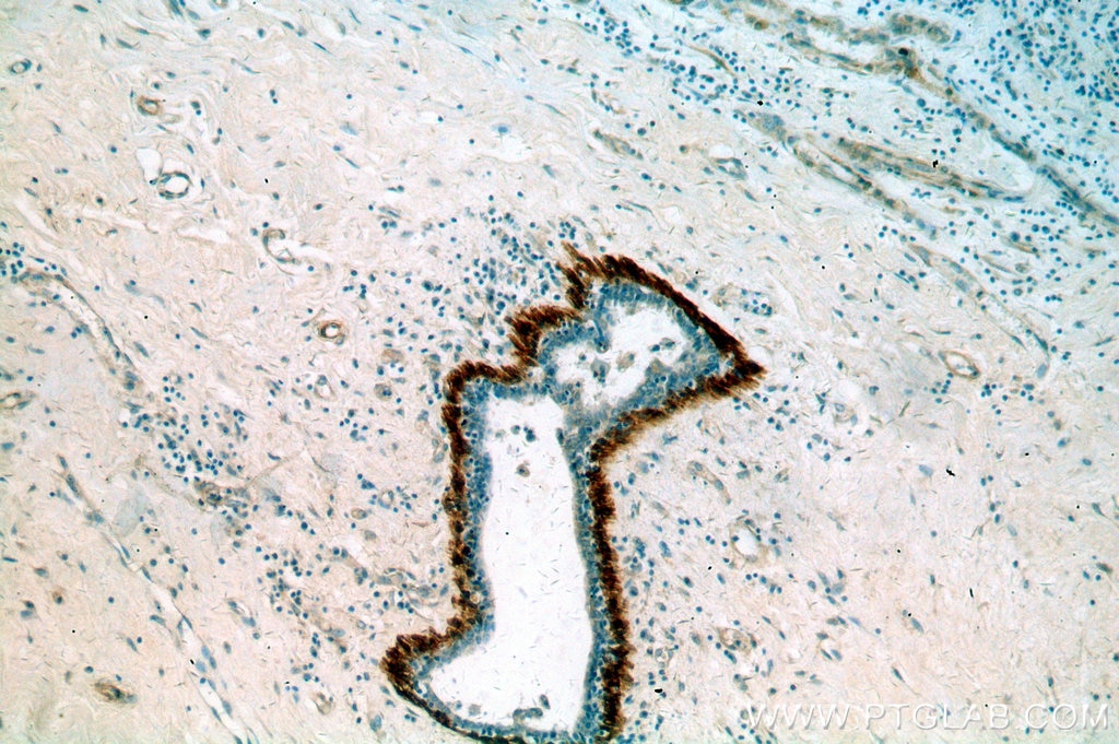 Immunohistochemistry (IHC) staining of human breast cancer tissue using Calponin Polyclonal antibody (13938-1-AP)