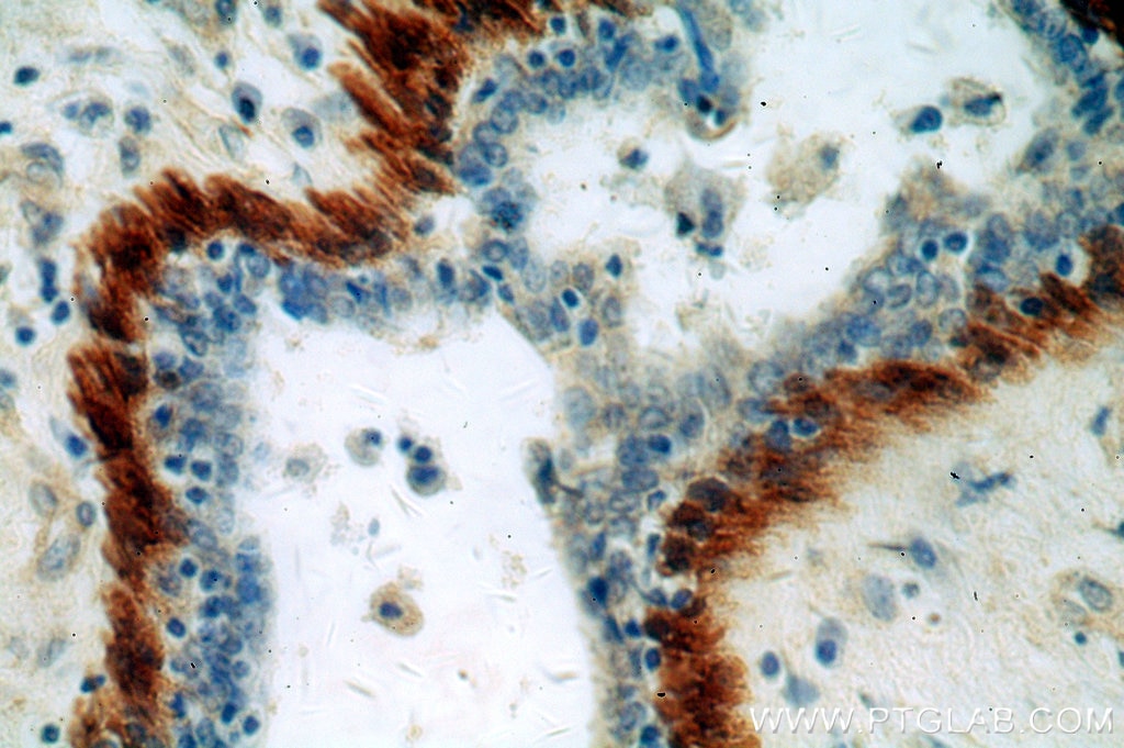 Immunohistochemistry (IHC) staining of human breast cancer tissue using Calponin Polyclonal antibody (13938-1-AP)