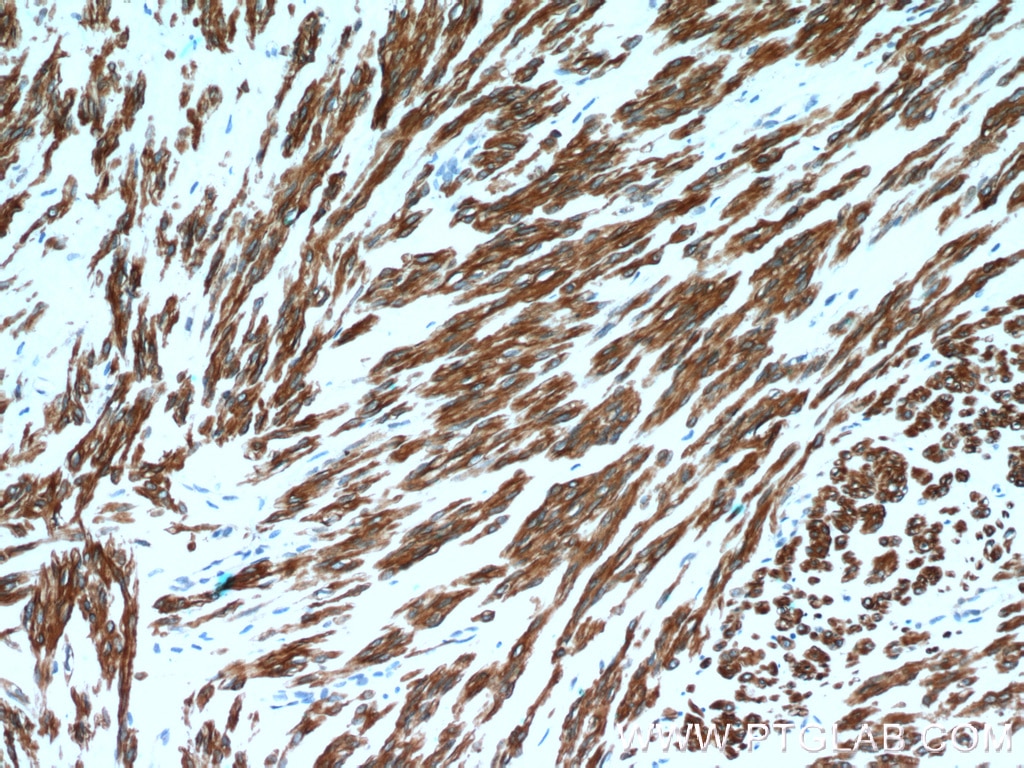 Immunohistochemistry (IHC) staining of human hysteromyoma tissue using Calponin Polyclonal antibody (13938-1-AP)