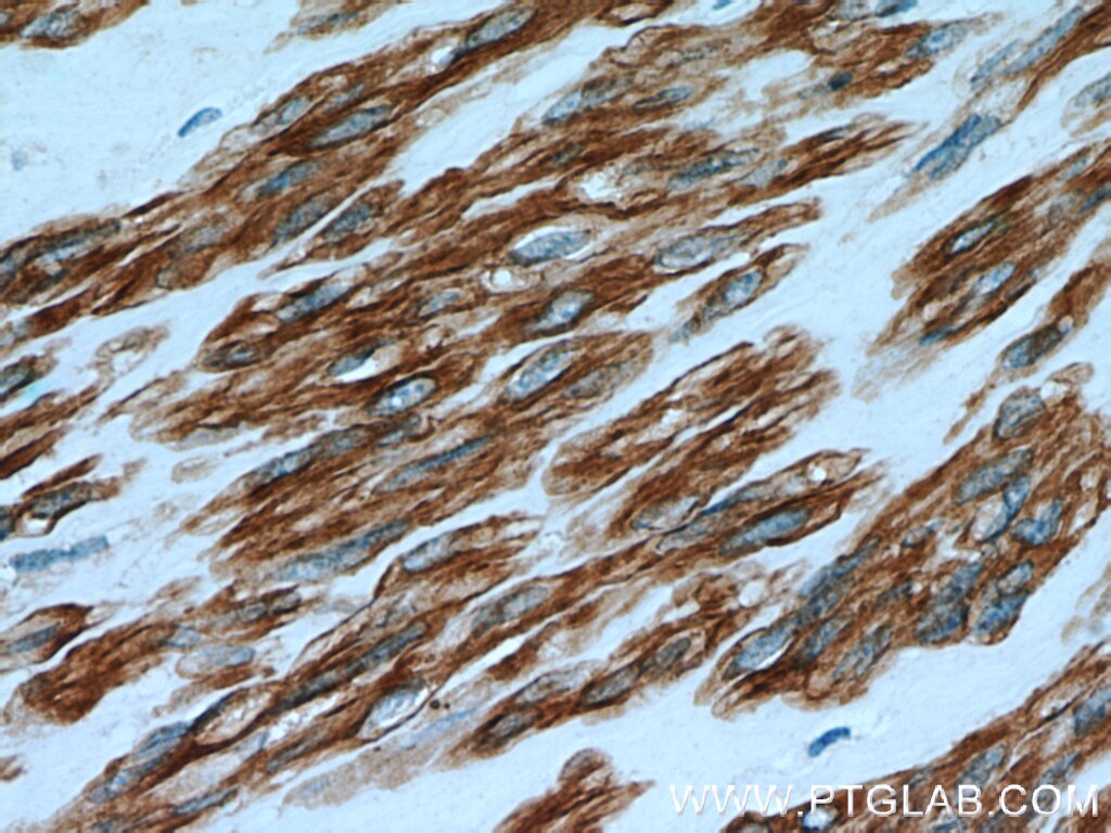 Immunohistochemistry (IHC) staining of human hysteromyoma tissue using Calponin Polyclonal antibody (13938-1-AP)