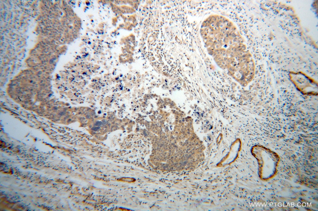 IHC staining of human ovary tumor using 13938-1-AP