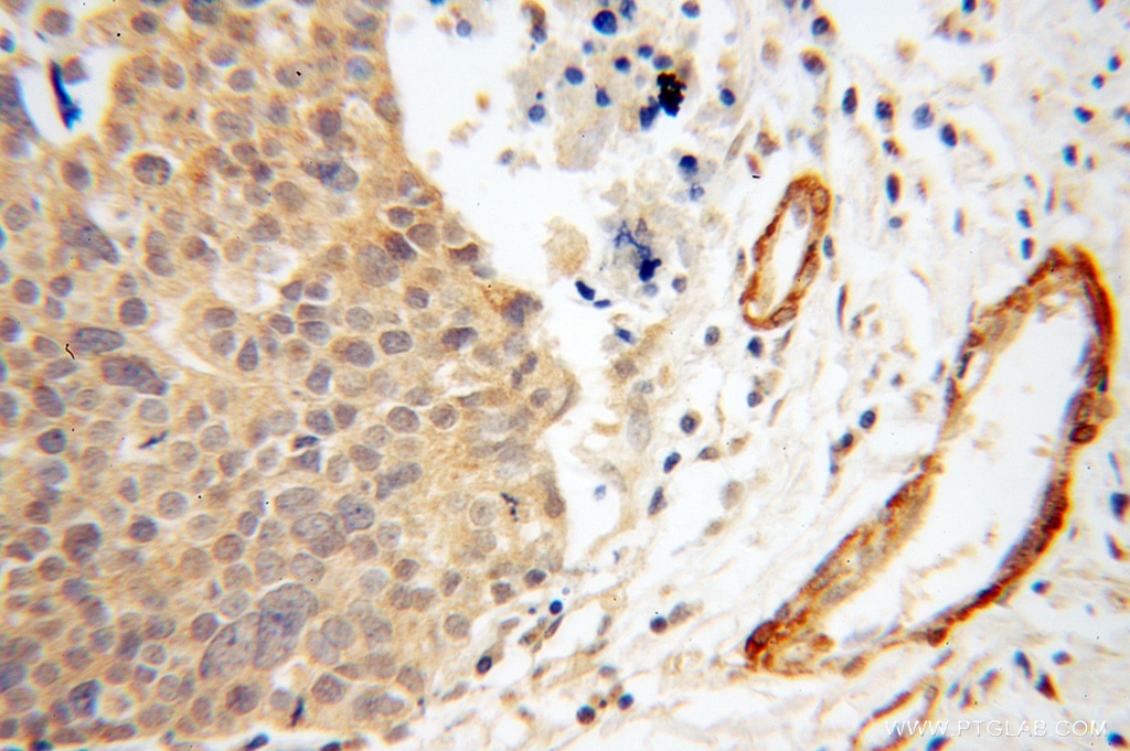 Immunohistochemistry (IHC) staining of human ovary tumor tissue using Calponin Polyclonal antibody (13938-1-AP)