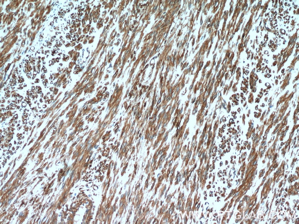 Immunohistochemistry (IHC) staining of human hysteromyoma tissue using CNN2 Polyclonal antibody (21073-1-AP)