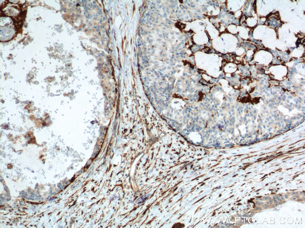 Immunohistochemistry (IHC) staining of human breast hyperplasia tissue using CNN2 Monoclonal antibody (66244-1-Ig)