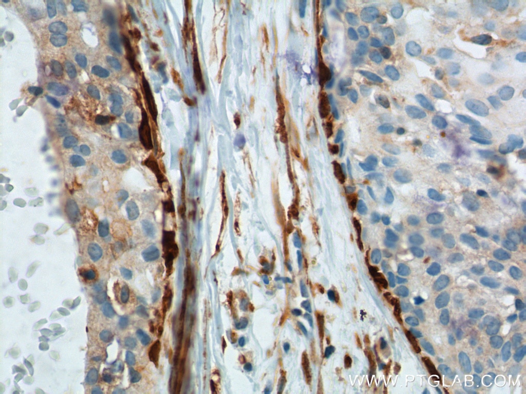 Immunohistochemistry (IHC) staining of human breast hyperplasia tissue using CNN2 Monoclonal antibody (66244-1-Ig)