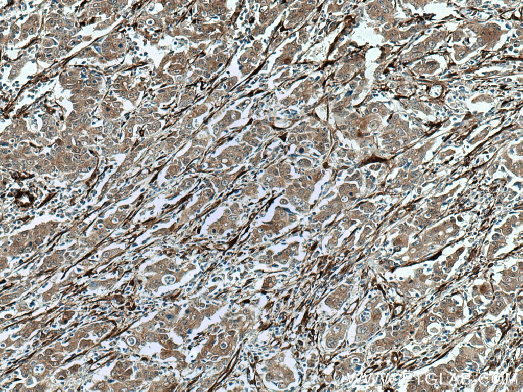 Immunohistochemistry (IHC) staining of human stomach cancer tissue using CNN3 Polyclonal antibody (11509-1-AP)