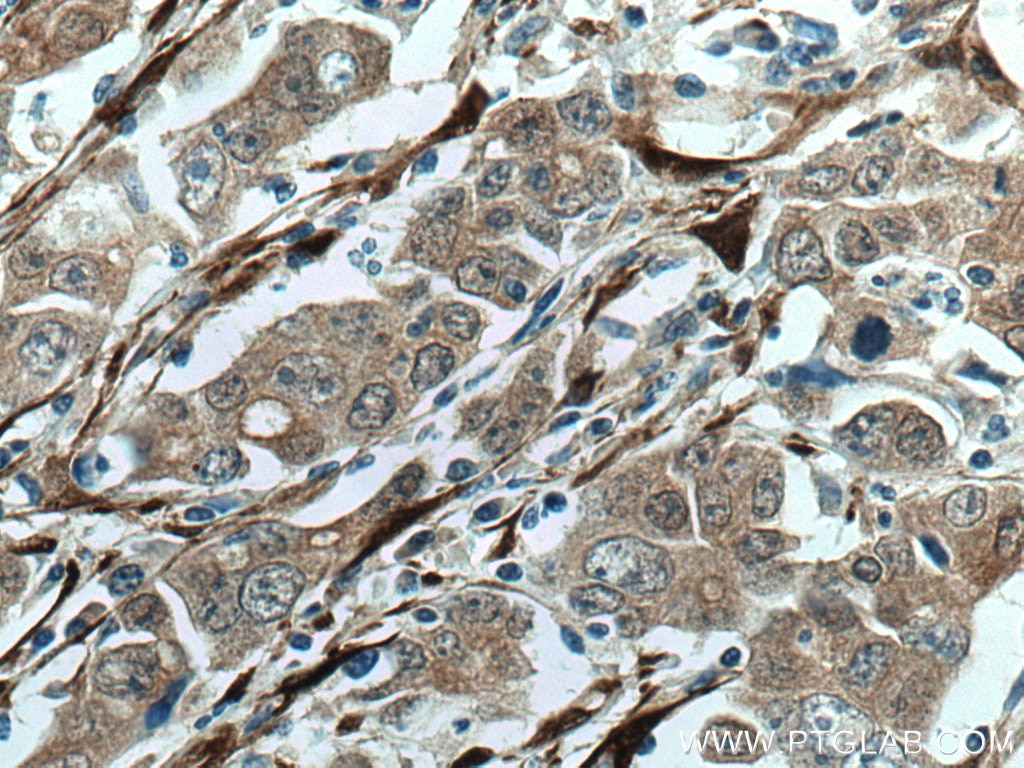 Immunohistochemistry (IHC) staining of human stomach cancer tissue using CNN3 Polyclonal antibody (11509-1-AP)