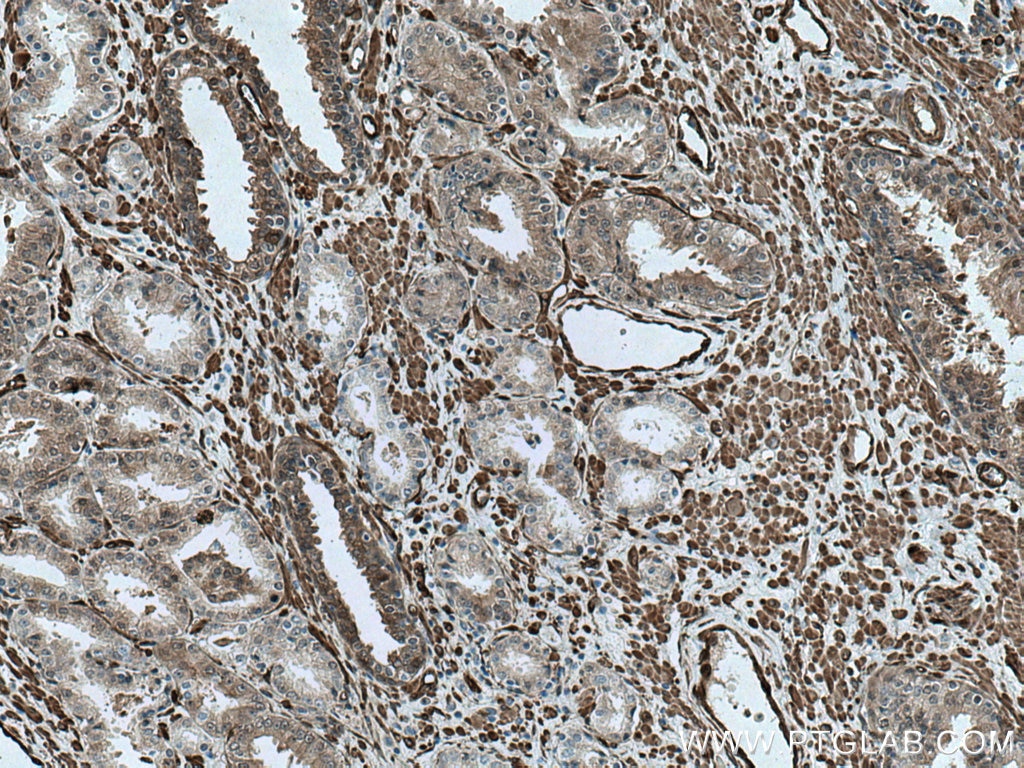 Immunohistochemistry (IHC) staining of human prostate cancer tissue using CNN3 Polyclonal antibody (11509-1-AP)