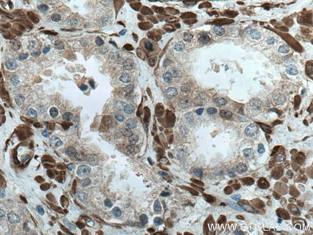 Immunohistochemistry (IHC) staining of human prostate cancer tissue using CNN3 Polyclonal antibody (11509-1-AP)
