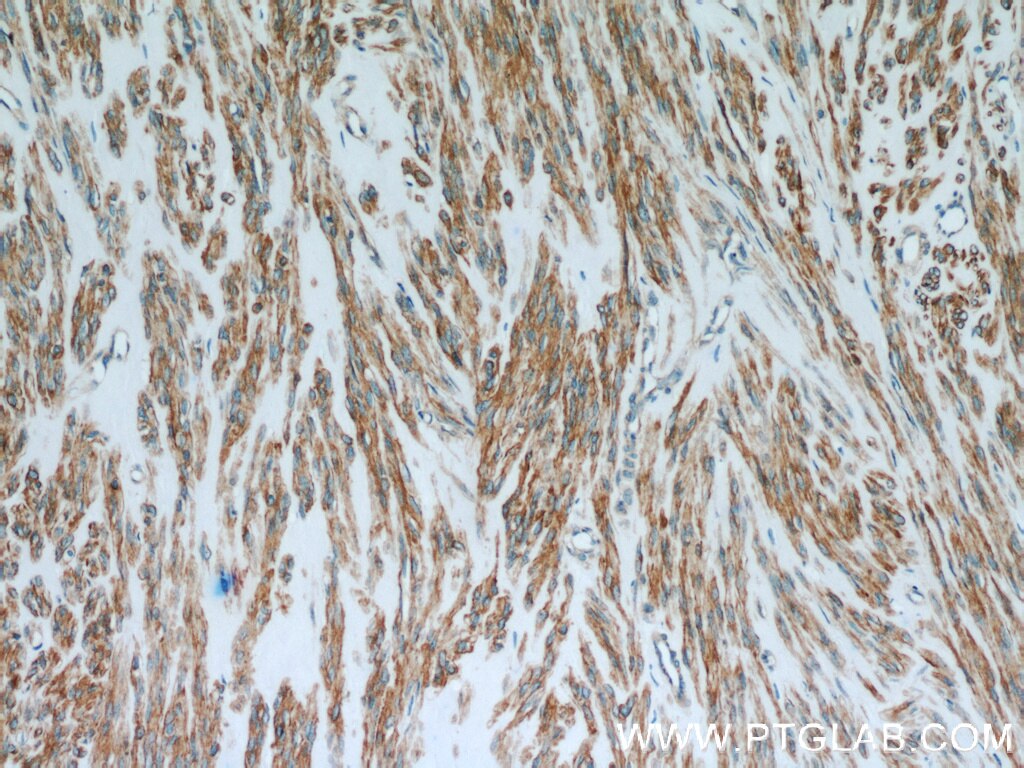 Immunohistochemistry (IHC) staining of human hysteromyoma tissue using CNN3 Polyclonal antibody (11509-1-AP)