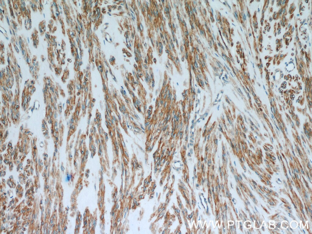 IHC staining of human hysteromyoma using 11509-1-AP