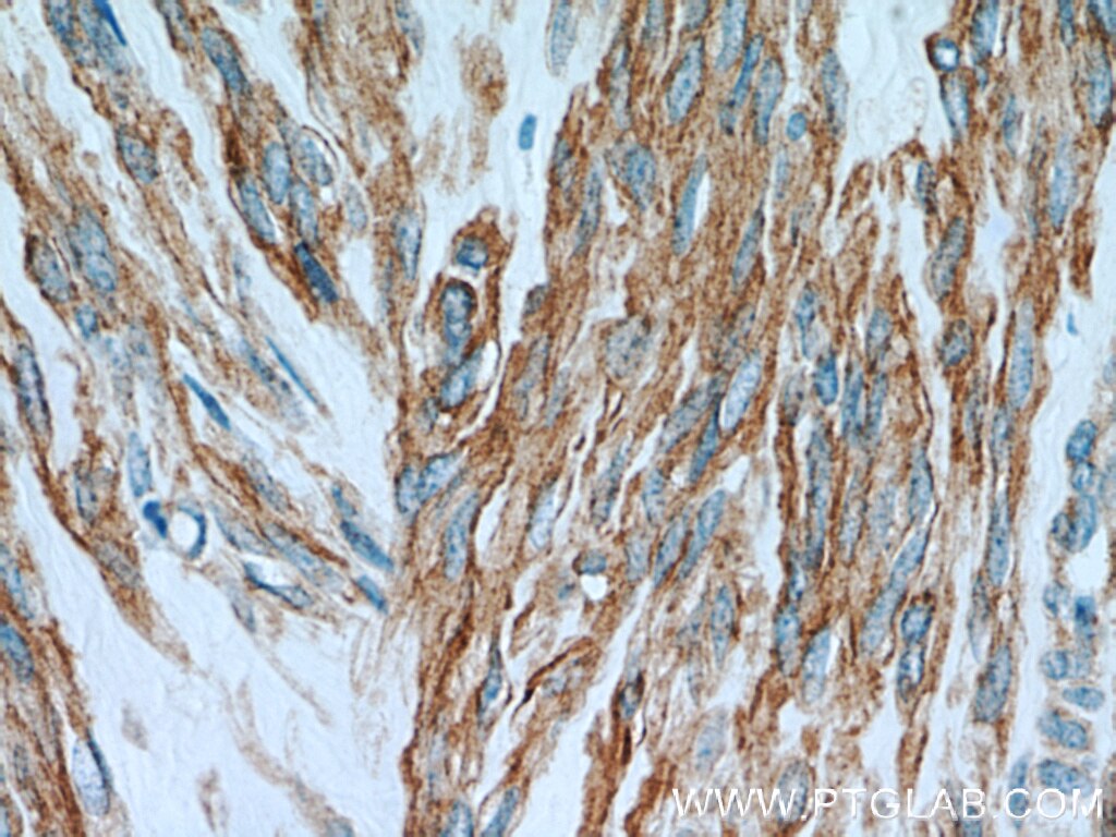 Immunohistochemistry (IHC) staining of human hysteromyoma tissue using CNN3 Polyclonal antibody (11509-1-AP)