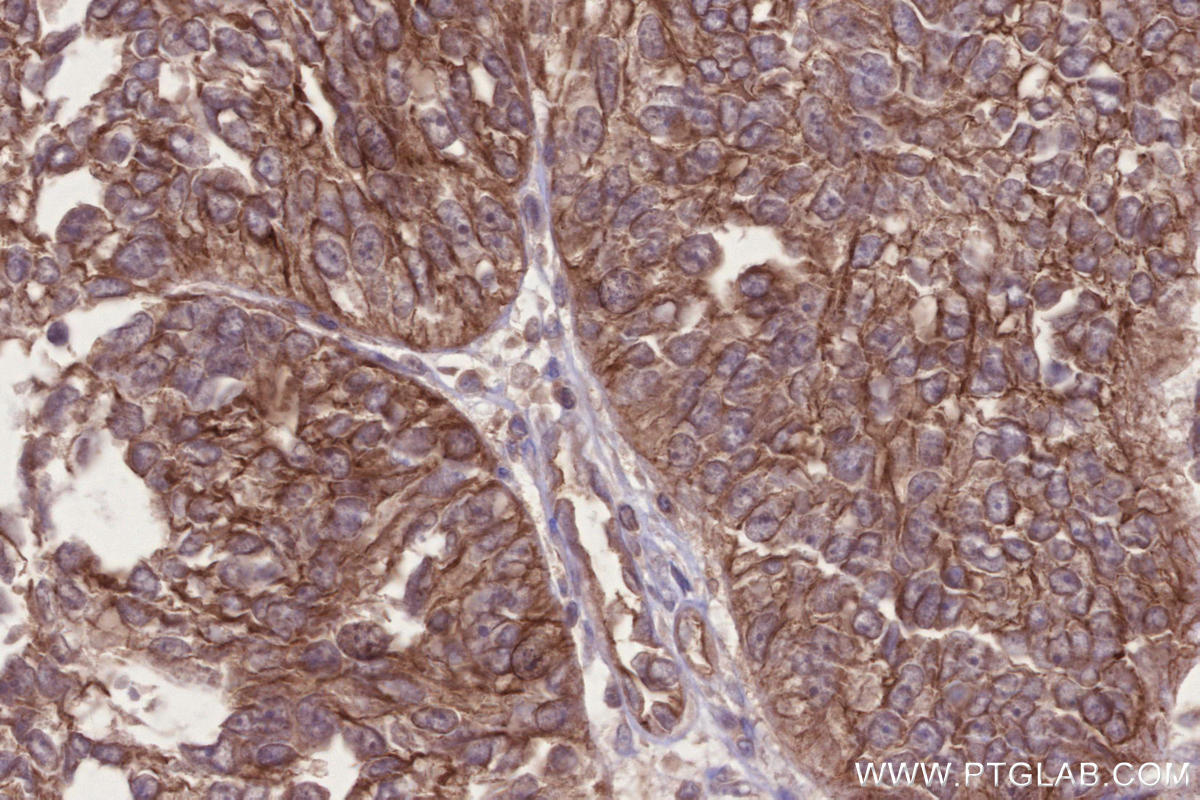 IHC staining of human ovary cancer using 13976-1-AP Immunohistochemistry (IHC) staining of human ovary cancer tissue using CNNM3 Polyclonal antibody (13976-1-AP)