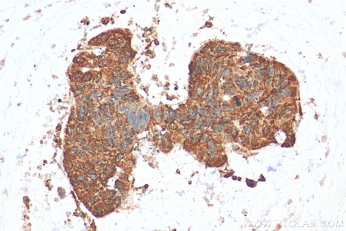 IHC staining of human colon cancer using 15938-1-AP