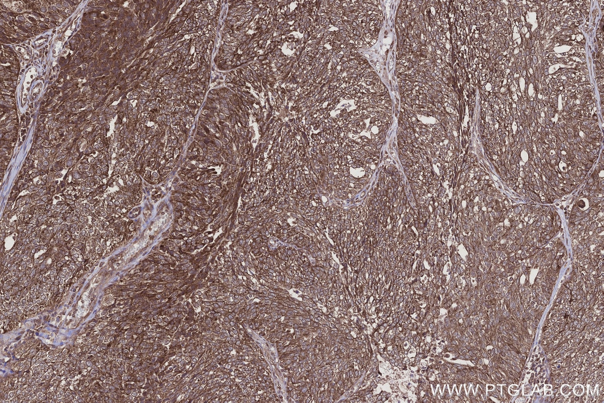 Immunohistochemistry (IHC) staining of human ovary cancer tissue using CNOT10 Polyclonal antibody (15938-1-AP)