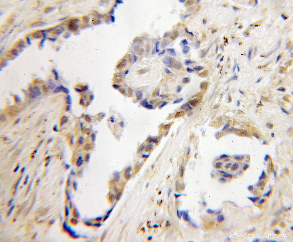 Immunohistochemistry (IHC) staining of human lung cancer tissue using CNOT4 Polyclonal antibody (12564-1-AP)