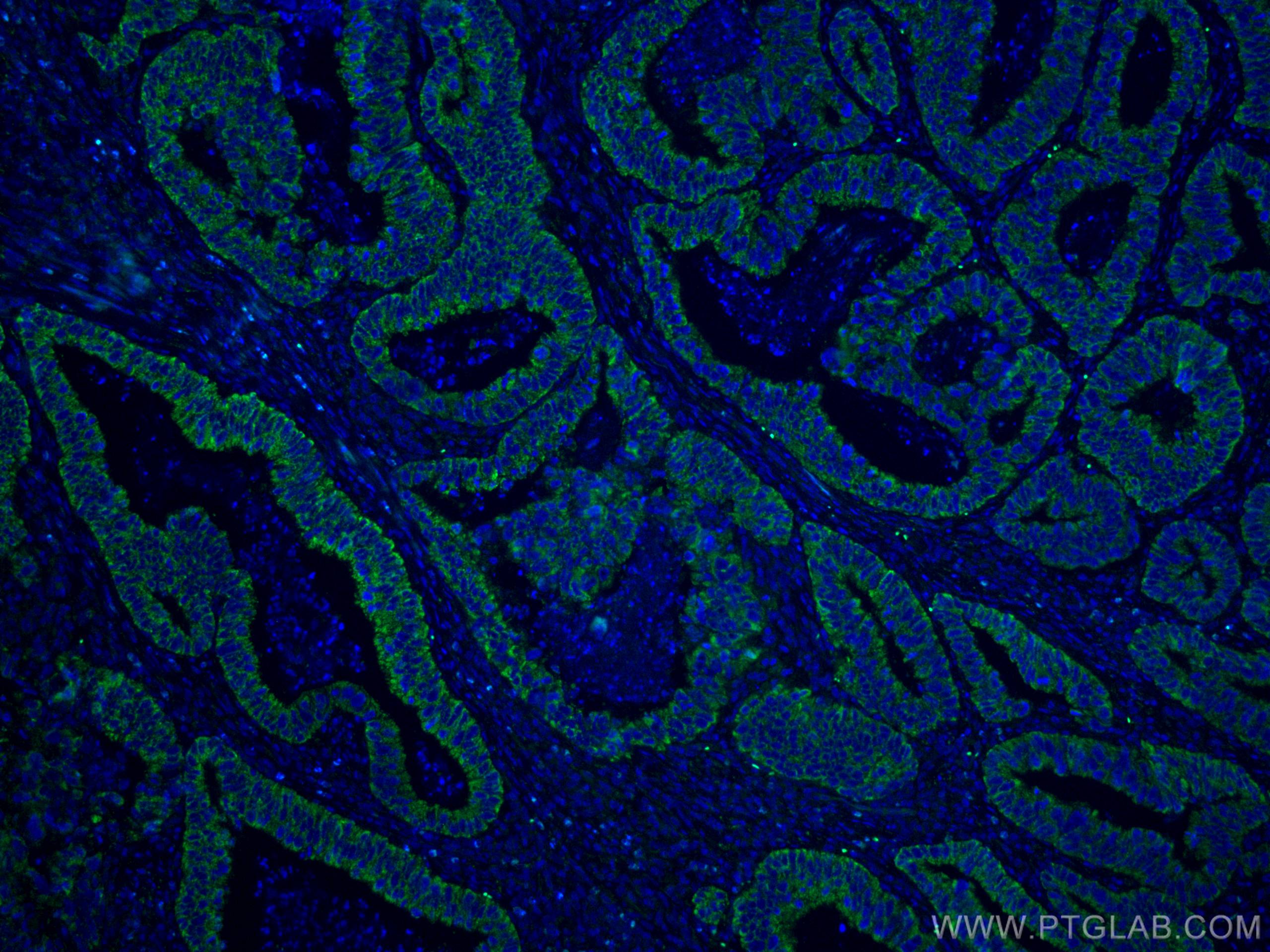 Immunofluorescence (IF) / fluorescent staining of human colon cancer tissue using CNOT4 Monoclonal antibody (67798-1-Ig)